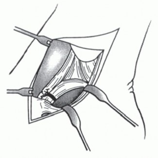 Illustration 22 for Medial Ankle Instability: Find Relief with Reconstruction