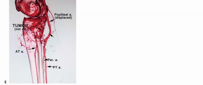 Illustration 5 for Complex Popliteal Resections: Protecting the Greater Saphenous Vein