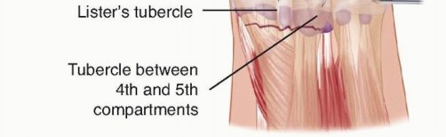 Illustration 9 for Effective K-Wire Fixation: Distal Radius Fractures Without External Fixation