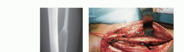 Illustration 30 for Beyond Amputation: The Type I Resection in Fibular Tumor Surgery