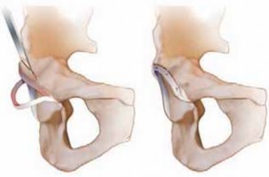 Illustration 25 for FAI: Impingement and Surgical Dislocation Explained