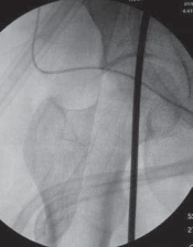 Illustration 24 for Guide Pin Assembly: Key to Flawless Upper Tibial Osteotomy