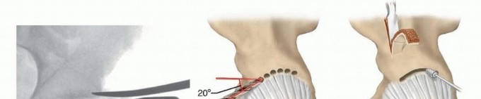 Illustration 9 for Labral Support Shelf Procedure: Preventing Perthes Deformity