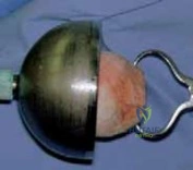 Illustration of arthroplasty with tibial bone - Dr. Mohammed Hutaif