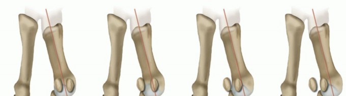 Illustration 3 for Mastering the Biplanar Distal Chevron for Effective Bunion Surgery