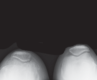 Illustration 8 for Cemented TKA Figure: Your Visual Guide to Surgical Success