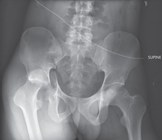 Illustration of traumatic hip dislocations - Dr. Mohammed Hutaif