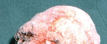 Illustration 5 for Expert Bone Grafting for Primary Total Hip Replacement Success