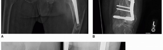 Illustration 18 for Mastering Revision THA: Strategies for Adverse Local Tissue Challenges