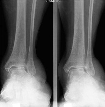 Foot & Ankle Pain: When radiographs are obtained, what do they reveal?