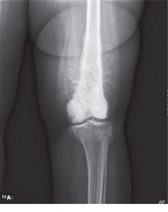 Illustration of orthopaedic oncology cases osteosarcoma - Dr. Mohammed Hutaif