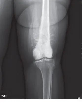 صورة توضيحية لـ الورم العظمي الغرني (الساركوما العظمية) في الفخذ: دليل شامل للمرضى والعلاج المتقدم في صنعاء مع الأستاذ الدكتور محمد هطيف