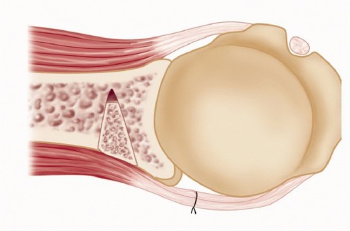 Illustration 32 for Mastering the Treatment of Recurrent Posterior Shoulder Instability
