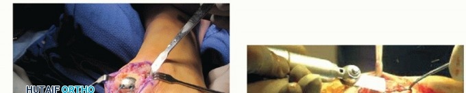 Illustration 37 for End Articular Cartilage Loss: Arthrosurface HemiCAP Resurfacing