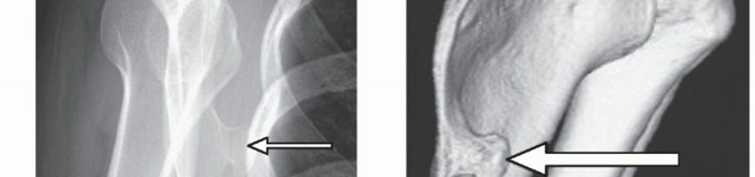 Illustration 9 for Solving Snapping Scapula: Is resection of the superomedial your option?