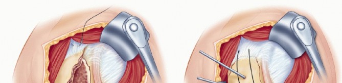 Illustration 7 for Optimizing Fixation of Proximal Humerus Fractures: A Guide