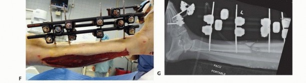Illustration 32 for Tibia External Fixation: See How Pins Are Placed for Healing