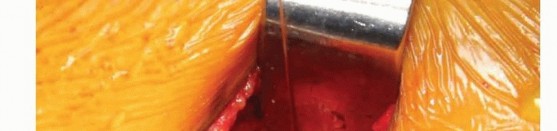 Illustration 39 for Anterior FAI Relief: Mini-Open Anterior Approach Explained