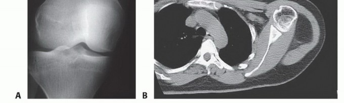 Illustration 25 for Precision Biopsy of Musculoskeletal Tumors for Accurate Diagnosis
