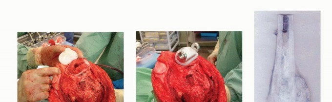 Illustration 10 for Expandable Prostheses: Understanding Infection Risk for Young Patients