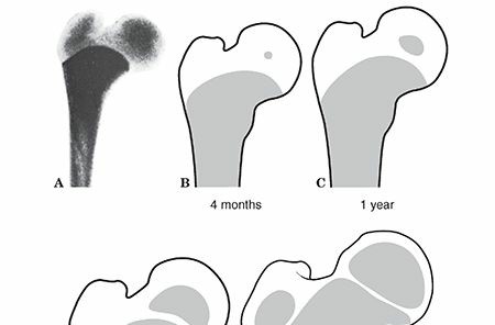 Pediatric Hip Fractures: What Every Clinician Must Know