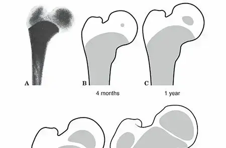 صورة توضيحية لـ كسور وخلوع مفصل الورك عند الأطفال: دليلك الشامل لرعاية طفلك مع الأستاذ الدكتور محمد هطيف