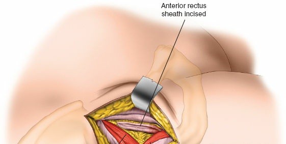 Illustration 87 for Unlocking Every Aspect of the Hip's Surgical Approaches