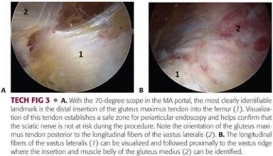 Illustration 117 for Periarticular Arthroscopy: Addressing Medius & Minimus Tears