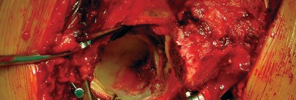 Illustration 25 for Cemented Component Longevity: The Critical Margin of the Acetabulum