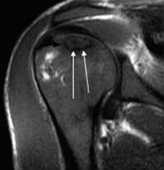 Illustration 2 for Steroids & Shoulder Pain: Diagnosing AVN of the Humeral Head