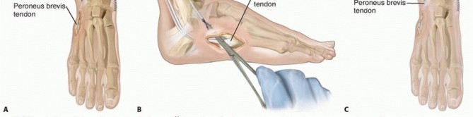 Illustration 4 for Preventing Overcorrection: Split Tibialis Posterior Tendon Transfer