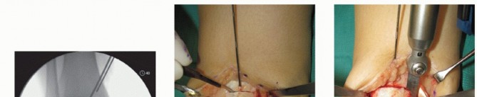 Illustration 3 for Unlock Healing: Medial Malleolar Osteotomy for Talus OLT Allografts