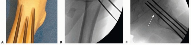 Illustration 11 for Is a Sliding Hip Screw Best for Your Femoral Neck Fracture?