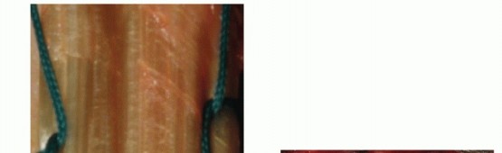 Illustration 34 for Distal Humeral Fractures: When Is Elbow Replacement the Best Option?