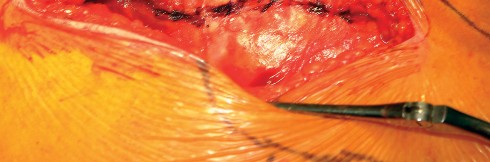 Illustration 26 for Direct Lateral Hip: Optimize Exposure with Sharp Curved Hohmann