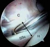 Illustration 19 for Arthroscopic Subscapularis Repair: The lo iky brady Method for Stability