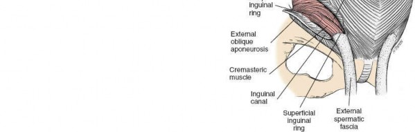Illustration 43 for Ilioinguinal Approach: Master the Deep Inguinal Ring for Success