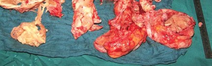 Illustration 20 for Optimizing Infected THA: The One Staged Approach Explained