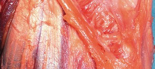 Illustration 27 for Mastering Valgus Total Knee Replacement: Techniques & Pitfalls