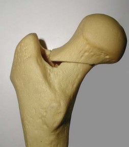 Illustration 11 for S-ROM: Inside the Technique of Modular Implant Design