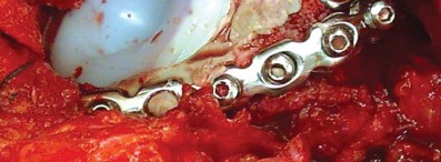 Illustration 29 for Management of Periprosthetic Fractures: An Expert Surgical Guide