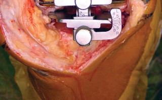 صورة طبية: استبدال مفصل الركبة بالحد الأدنى من التدخل الجراحي: ألم أقل وتعافٍ أسرع مع النهج شبه الرضفي الإنسي