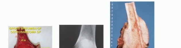 Illustration 38 for Understanding Benign Bone Tumors: Your Complete Preoperative Guide