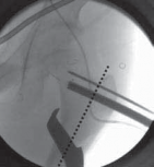 Illustration 15 for Increased Femoral Anteversion: A Proximal Femoral Rotational Osteotomy