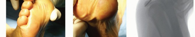 Illustration 12 for Optimizing Internal Fixation of Sesamoid Fractures