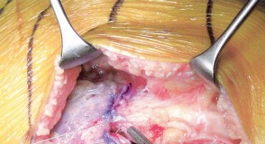 Illustration 23 for Minimally Invasive Subvastus: The Best Path to Quicker TKA Recovery