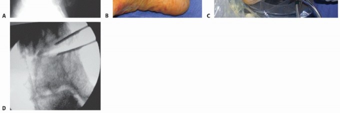 Illustration 11 for Unlock Ankle Preservation: Supramalleolar Closing Wedge Osteotomy
