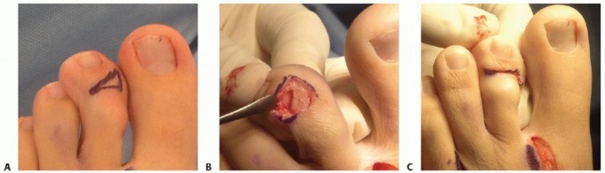 Illustration 23 for Toe Deformity Pain? Rebalance Flexor to Extensor for Relief