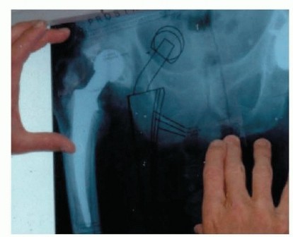 Illustration 4 for Hip Reimplantation Surgery: The Solution for Infected Implants