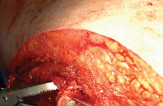 Illustration 83 for Femoral Stem Revision: Posterior Approach for Better Outcomes